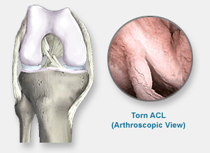 acl torn2